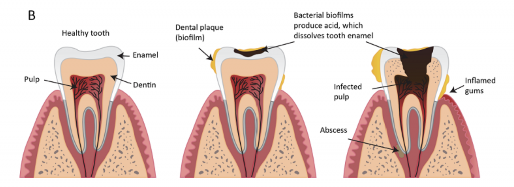 Biofilm decaying tooth enamel
